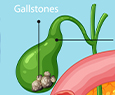 Gallstone