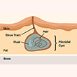 Pilonidal Sinus