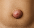 Umbilical Hernia