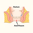Anal Fissure