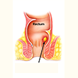 Anal Fistula
