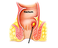 Anal Fistula