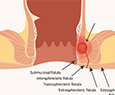 Suprasphincteric Fistula