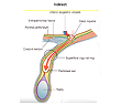 Indirect inguinal hernia
